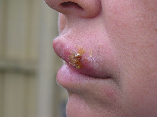 10 Interesting Facts about Herpes