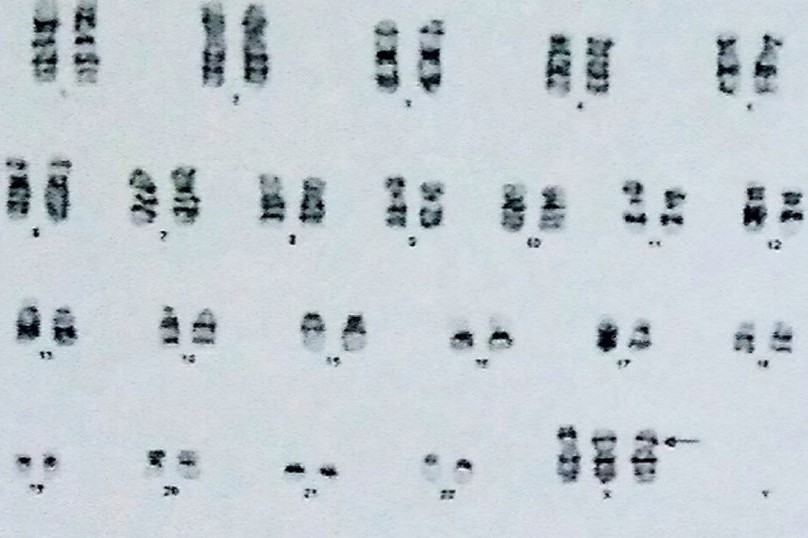 Karyotype of trisomy X